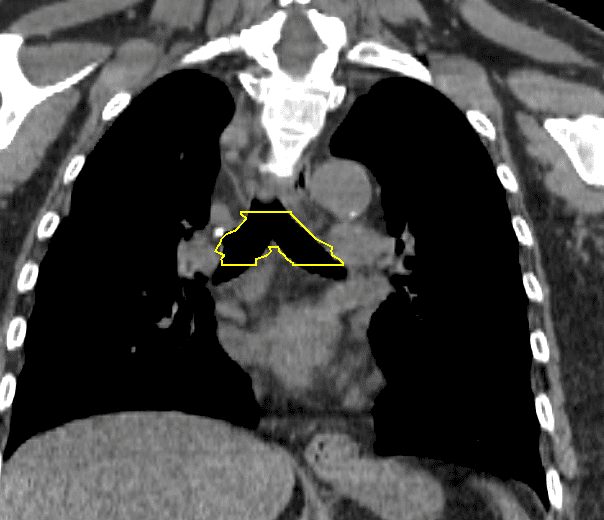 Carina – Oncology Medical Physics