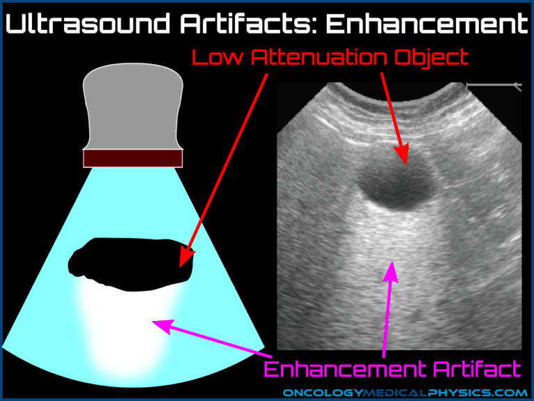Ultrasound Artifacts | Oncology Medical Physics