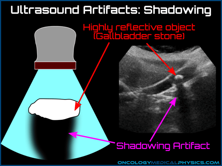Ultrasound Artifacts | Oncology Medical Physics
